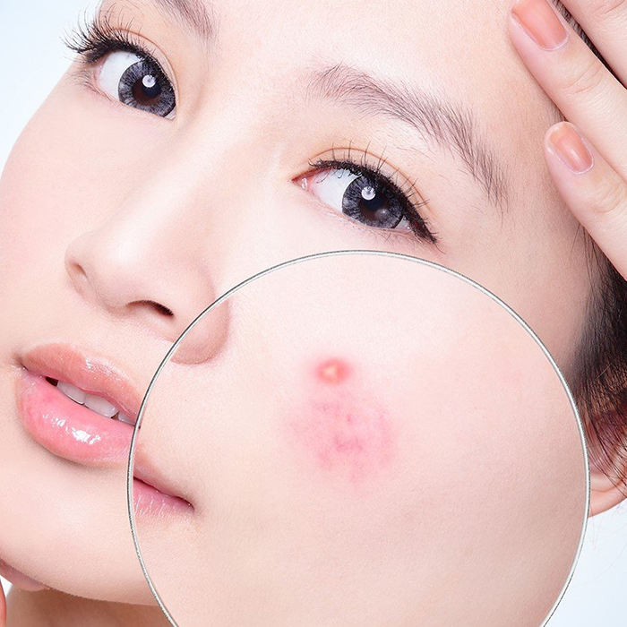 Cách làm xẹp nốt mụn sưng đỏ tại nhà