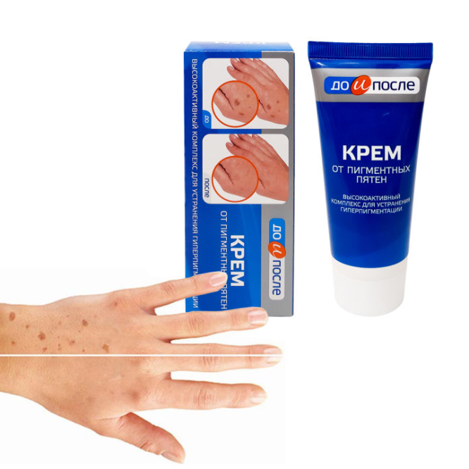 Kem Tay Kpem Trị Đồi Mồi , Vết Nám , Sạm Đốm Nâu Da Tay 50ml