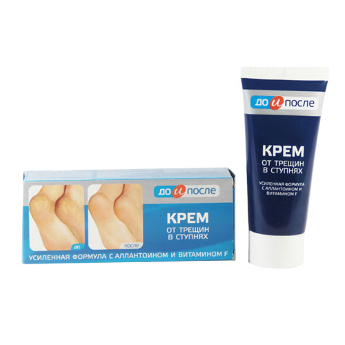 Kem Trị Nứt Gót Chân Kpem Chính Hãng Nga